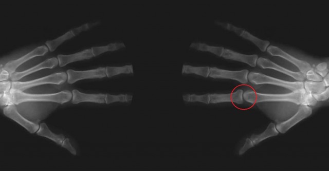 What happens to your knuckles when you crack them