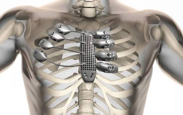 3D printed ribs