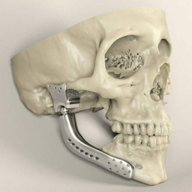 3D-printed medical implants