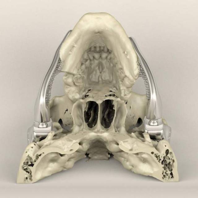 3D-printed medical implants 2