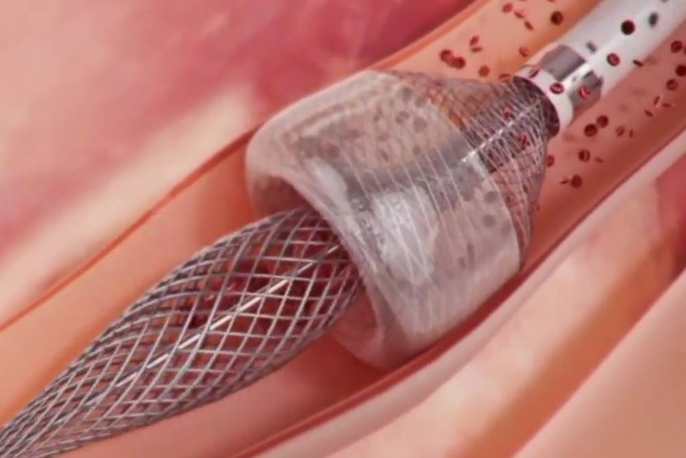 New procedure can safely remove Blood Clots