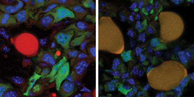New method converts Breast Cancer Cells into fat Cells