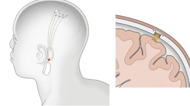 Neuralink plans its first brain chip implants