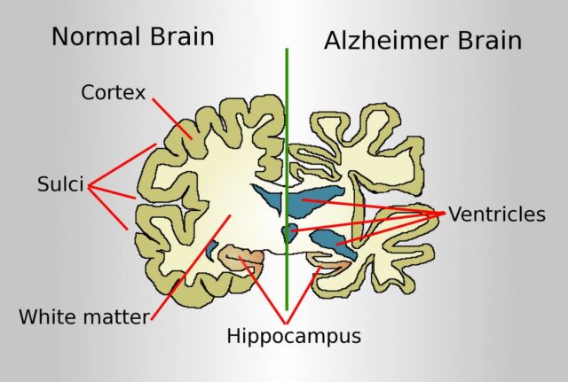 Approval for Alzheimer’s Drug