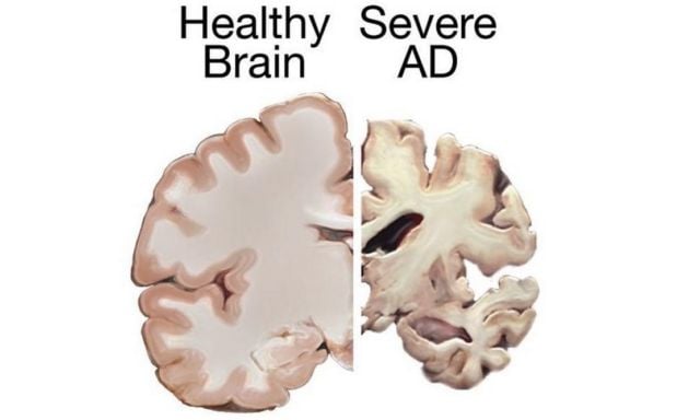 Approval for Alzheimer’s Drug