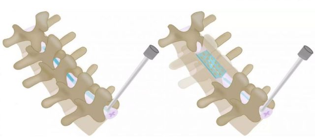 Inflatable Spinal implants to treat Severe Pain 