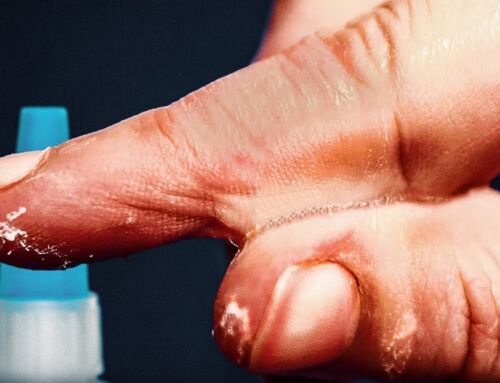 Super Glue Is Perfect For Gluing Skin